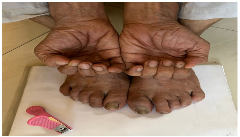 Click here to view Large Figure 1 biomedres-openaccess-journal-bjstr